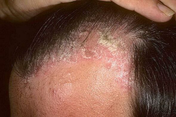 Symptômes du psoriasis