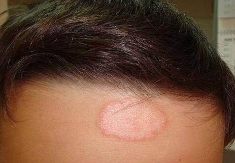 Point psoriatique