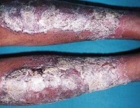 Pommade au psoriasis