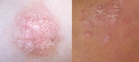 Psoriasis au stade initial